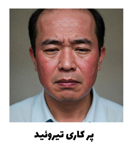 پرکاری تیوئید